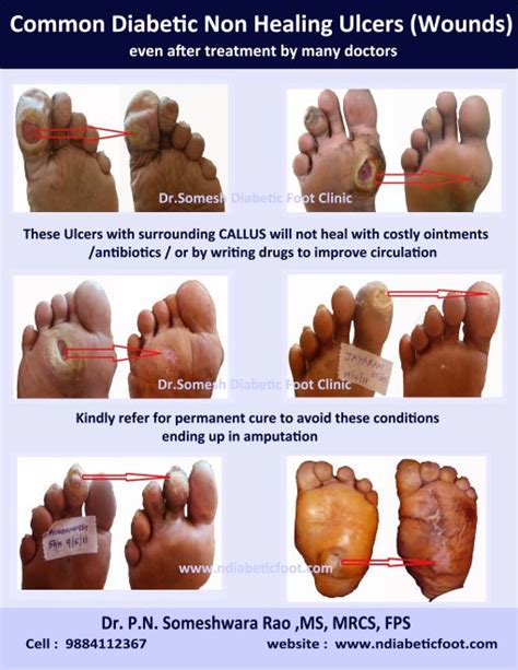 Diabetic ulcers are the most common foot injuries leading to lower extremity amputation. Non healing Diabetic Ulcer locations - Podiatry Doctor