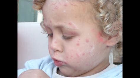 Other nonoral herpes simplex virus type 1 infections include herpetic keratitis, herpetic whitlow, herpes gladiatorum, and herpetic sycosis of the beard area. Shingles In Children, Signs Of Shingles, Herpes Zoster ...