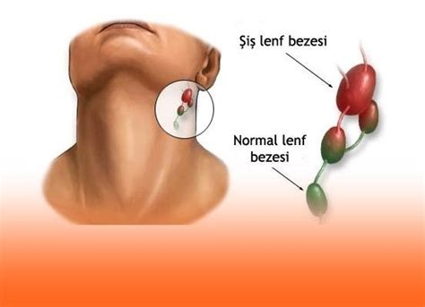 Lenfoma kanseri geniş olarak iki kategoriye ayrılabilir lenfoma kanseri her yaşta ortaya çıkmasına rağmen, hodgkin hastalığı en çok iki özel yaş grubunda. Lenfoma Kanseri ve Tedavisi