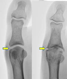 Doctor examines the patient's leg with heel spurs, pain in the foot, white. Big Toe Joint Conditions - Ottawa Foot Clinic