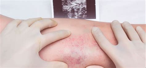 Una trombosis venosa es la formación de un coágulo de sangre en el interior de una vena, que puede deberse a un problema de hipercoagulabilidad, lesiones de la pared del vaso o a un problema de éxtasis (estancamiento) de la sangre. ¿Qué es la trombosis venosa profunda? | Revista Salud y ...