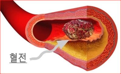 덴마크가 아스트라제네카(az) 코로나 백신 접종을 잠정 11일(현지 시각) bbc 등에 따르면 덴마크 보건당국은 백신 접종자 중 혈액이 응고되는(혈전). ★진달래교회★ | 뇌경색치료 '혈전용해제'와' 항응고제'에 대해 ...