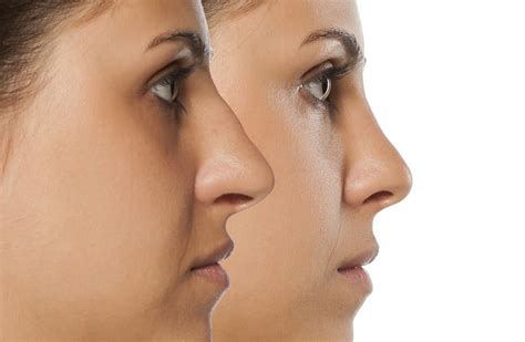 Most nose surgeries are done as cosmetic surgeries only, thus they are not considered by insurance companies. Cosmetic vs Medical Reasons for a Nose Job (Rhinoplasty) in Houston