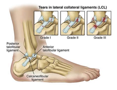 The upper part of the ring is formed by the articular surfaces an ankle sprain refers to partial or complete tears in the ligaments of the ankle joint. Ankle Ligament Surgery and Recovery Timeline | New Health ...