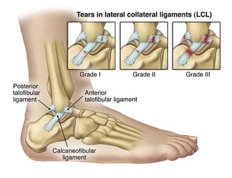 For mcl sprain, it grades 1, 2, or 3 depending on the injury's symptoms/severity. Ankle Ligament Surgery and Recovery Timeline | New Health ...