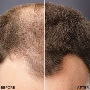 Toppik hair fibres has helped millions of people who suffer from a range of hair loss disorders to transform the way they look. Toppik Coloured Hair Thickener - Hair Loss Ireland