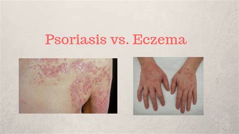 10000 kali lebih kuat dari kemoterapi! Ekzema vs Psoriasis! Apakah perbezaannya? - Mudahnya nak ...