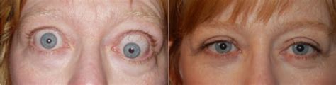 Severe eye pain or irritation vision loss or double vision Thyroid Eye Disease | Eye Conditions | Shiley Eye ...