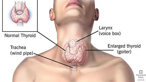 Discover 10 common thyroid cancer symptoms at 10faq health and stay better approximately 1% of all newly diagnosed cancer in the united states annually are thyroid cancers. Health Watch: Spotting thyroid problems - ABC30 Fresno