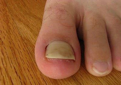 Often, only one nail is affected. Juwita Blog: Health Tips Facts - Yellow Toenails Symptoms ...