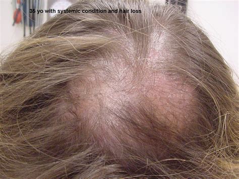 Discoid lupus lesions may cause severe and permanent damage to the scalp and hair follicles, and the hair loss is irreversible. Alopecia | Diseases & Conditions | 5MinuteConsult