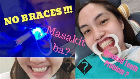 Since few families can afford to pay an 8 000 dental bill you should look for ways to qualify for free or discounted braces. How to straighten your teeth without BRACES faster | Pain ...