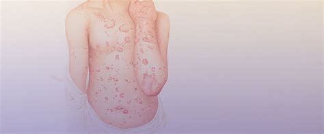 Detta vaccin ska inte ges till personer under 16 år. Borreliavaccin kan snart bli verklighet - Tbe.se