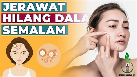 Ada cara menghilangkan jerawat yang tidak membahayakan. 5 Cara Menghilangkan Jerawat Serta Bekasnya Dengan Cepat ...