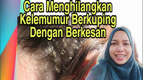 Selain dapat dimanfaatkan untuk mempercepat rambut tumbuh, campuran perasan lemon dan sari bawang merah juga bisa dimanfaatkan sebagai cara. Cara Menghilangkan Kelemumur Berkuping Dengan Cepat - YouTube