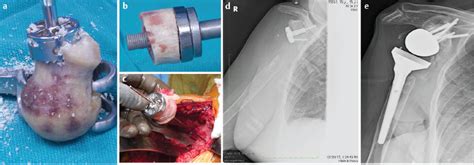 However, the nidcr points out that there are studies that establish a potential link between. 25 Dealing with Glenoid Bone Loss in Reverse Shoulder ...