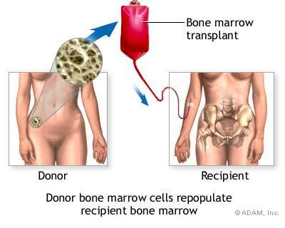The most frequent sarcomas are. Bone marrow transplant. Causes, symptoms, treatment Bone ...