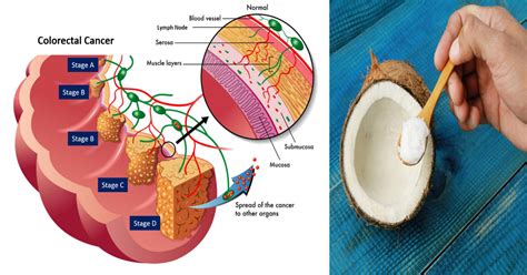 I want to know if two dates are from the same day! Coconut Oil Exterminates >93 Percent of Colon Cancer Cells ...