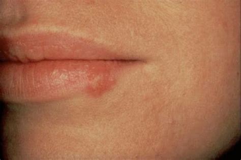 I dirimpettai: L'herpes alle labbra: difendiamoci e ...