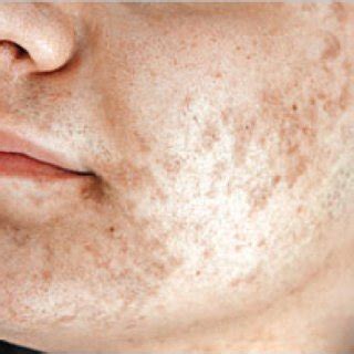 Reactivation of hsv 1 from dormancy leads to vesicle formation, pustulations, ulcerations, and scabbing involving the mucosa of the. Preoperative extraoral photograph of a patient with herpes ...