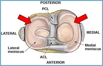 Durch abscherung bei einem verdrehen des kniegelenks), da der meniskus vor allem durch drehung in beugestellung des kniegelenkes belastet wird. Meniskusriss - kleiner Schaden mit Konsequenzen | Outdoor