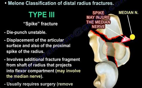 The radius or radial bone is one of the two large bones of the forearm, the other being the ulna. Distal Radius#: Melone Classification ...