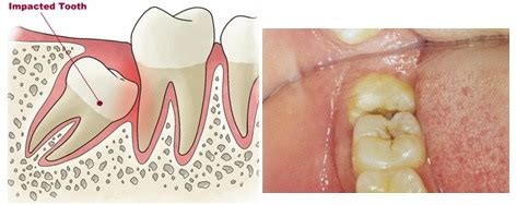 Read our quick diy remedies to dull tooth pain, so that you can fall asleep tonight. What are the major causes & effects of toothache? How do ...