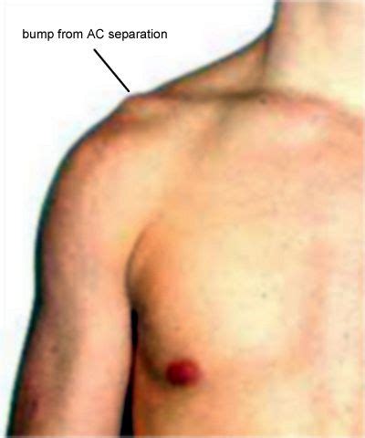 A lump on the shoulder blade could be indicative of many things. In the Corner with the Ring Doc: The Separated Shoulder