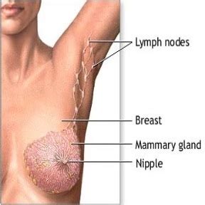 Learn how pathologists stage breast cancer according to the appearance and spread of malignant cells. Stage 1 Breast Cancer: Symptoms & Treatments