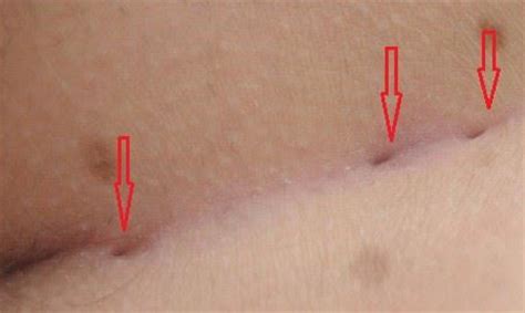 Fistulas may also develop after rapid increases in intracranial pressure, such as may occur with fistulas are infrequently present from birth. Analfistel (Perianalfistel) || Med-koM