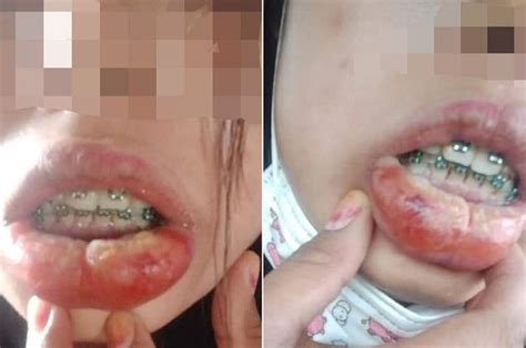 Gigi palsu lepasan jenis akrilik paling ekonomis dibandingkan gigi palsu lepasan lainnya. Pasang Kawat Gigi Palsu, Bibir Gadis Ini Langsung Bengkak ...