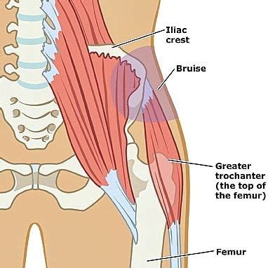 29 hip and groin injuries groin strain etiology injury usually occurs to the adductor longus moi = running, jumping, or twisting with hip 43 the snapping hip phenomenon etiology common in young female dancers, gymnasts, and hurdlers moi = repetitive movement that leads to muscle imbalance. Groin Female Hip Muscle Anatomy / Hip Flexor Strain ...