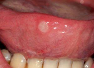 Pictures of harry tongue, lip cancer, tonsillitis, oral herpes, tongue cancer, throat and mouth ulcers, oral cancer, salivary galand stones pictures and other disease which treatment involves good oral hygiene, brushing of the tongue, mouth rinses and sometimes the trimming of the elongated papilla. Healthoolherpes on back of tongue pictures image photo | Healthool
