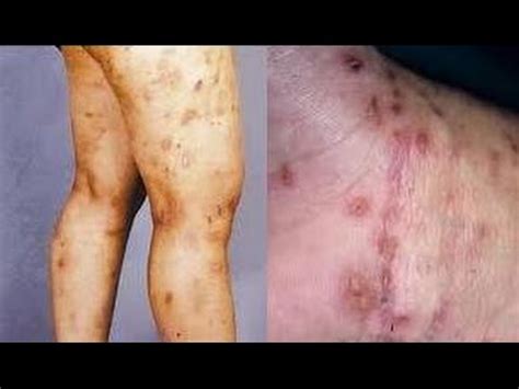 Namun, perlu diperhatikan bahwa proses penggosokan kulit yang kapalan menggunakan kulit lemon ini harus. 4 Cara Cepat Hilangkan Koreng di Kaki - YouTube