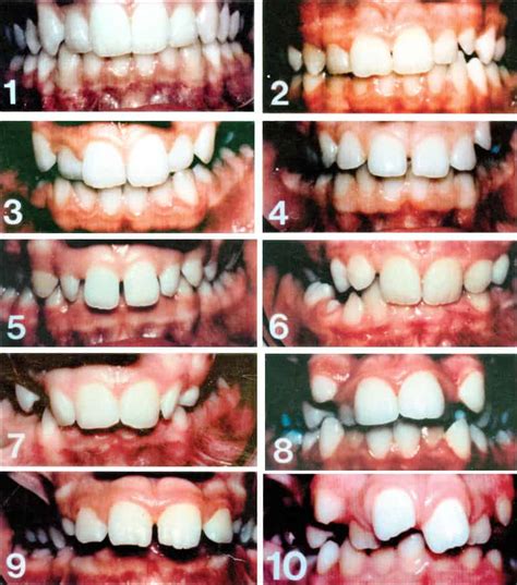 Setelah itu, dapatkan pemeriksaan daripada pakar ortodontik untuk menentukan tahap keterukan masalah gigi dan. Rimas Pakai 'Braces' Lama-Lama? Ini Sebab Kenapa Anda ...