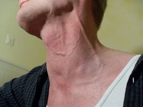 neck-veins-my-veiny-neck-flue2010-flickr