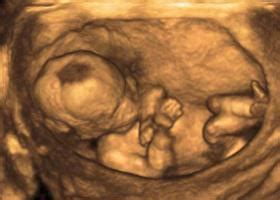 Bilder waren ok, baby war noch nicht zu groß, hatte nur leider ständig die hände vorm gesicht. 41 Best Photos 3D Ultraschall Wann Am Besten - 3D / 4D ...