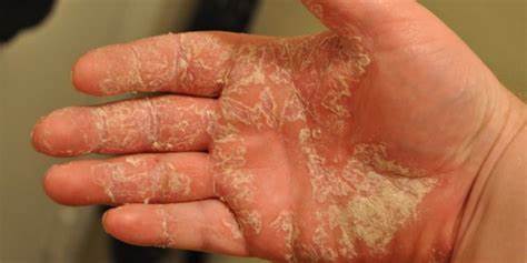 Экзема истинная диета Истинная экзема: фото, симптомы, причины, методы лечения и профилактики Истинная экзема: фото, симптомы, причины, методы лечения и профилактики Экзема истинная диета