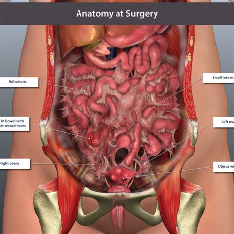 A good amount of area is covered by the abdominal wall. Abdominal Anatomy at Surgery - TrialExhibits Inc.
