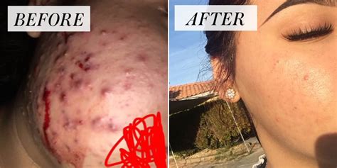 I could go a week without washing my hair, which was never possible for me before. Teen Says Green Tea and Honey Cleared Cystic Acne - Before ...