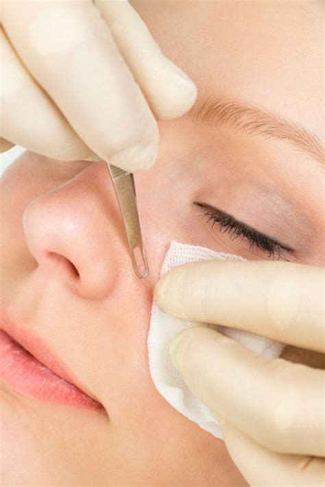 How to remove blackheads from nose with a tool. What triggers blackheads? What are the ways in which the ...