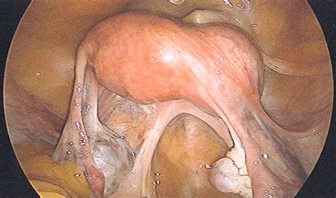 And tendons connect muscle to bone. Endometrioma contained within the broad ligament | BMJ ...