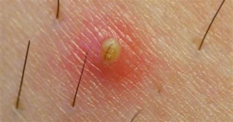 .likely experiencing ingrown hairs, especially if you shave your pubic hair or wear tight underwear and trousers. Deep Ingrown Hair, How to Remove on Neck, Bikini, Face ...
