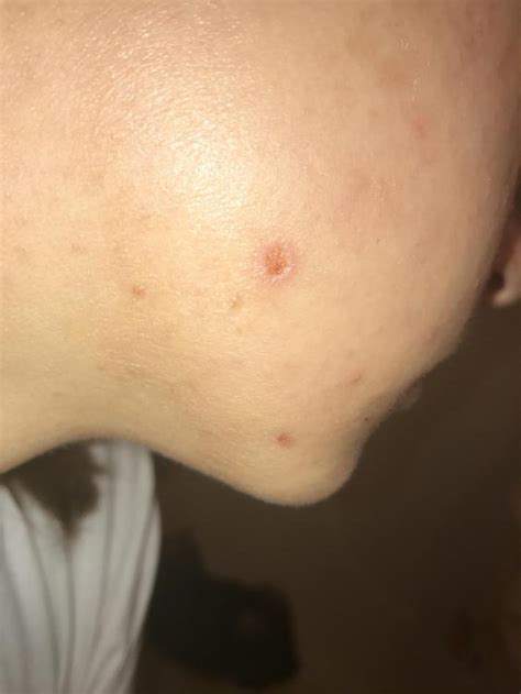 Maybe you would like to learn more about one of these? HELP!! picked scab too soon, hole on cheek! - General acne discussion - Acne.org