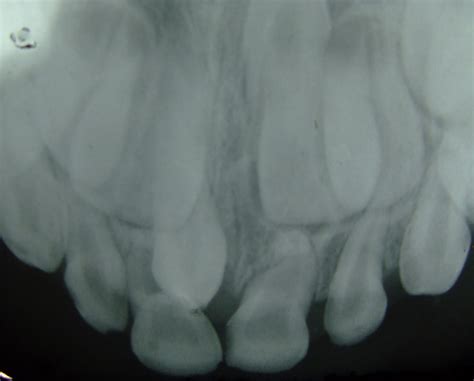 The exact etiology of supernumerary teeth remains largely prompt management and prevents the need for extensive treatment and development of associated the mesiodens in the early mixed dentition stage. File:Supernumerary teeth.jpg - Wikimedia Commons