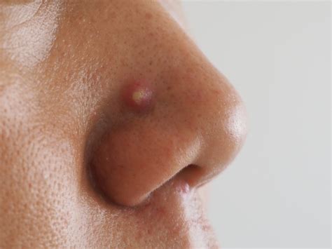 A painful bump on the surface of the nose may be a pimple. Pimples On Nose: Types, Causes, Treatments, Herbal ...