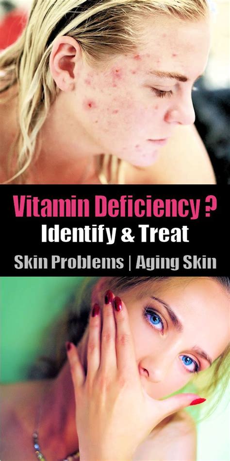 Nutrition for healthy skin vitamin a, zinc, c chris kresser. Vitamins deficiency crucial realities and tips for skin to ...