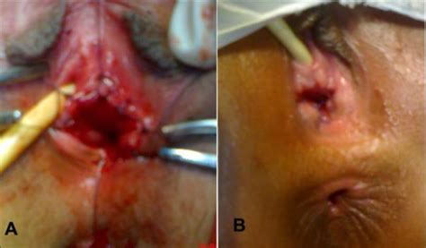 Müllerian agenesis (including absence of the uterus, cervix and/or vagina) is the cause in 15% of cases of primar. A, Completed procedure. B, At 2 weeks follow up after ...