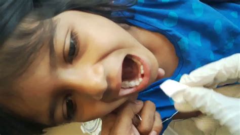 When you are missing a tooth, you can replace it with the diy tooth. DIY How to pull tooth out at home dental extraction, a brave 5 years old girl no blood bath ...
