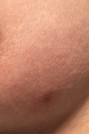Learn the causes of breast lumps how often are breast lumps cancerous? Small hard lump on breast - BabyCenter